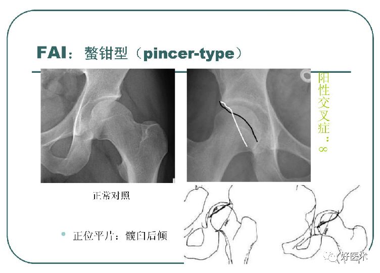 什么是“髋关节撞击综合征”？本文告诉你！