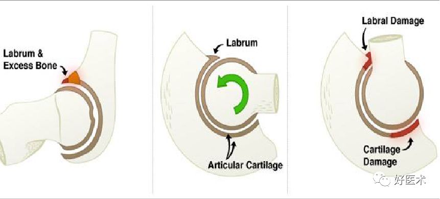什么是“髋关节撞击综合征”？本文告诉你！