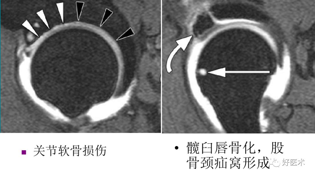 什么是“髋关节撞击综合征”？本文告诉你！