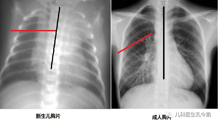 肋骨外翻是为什么？为什么说和缺钙无关？