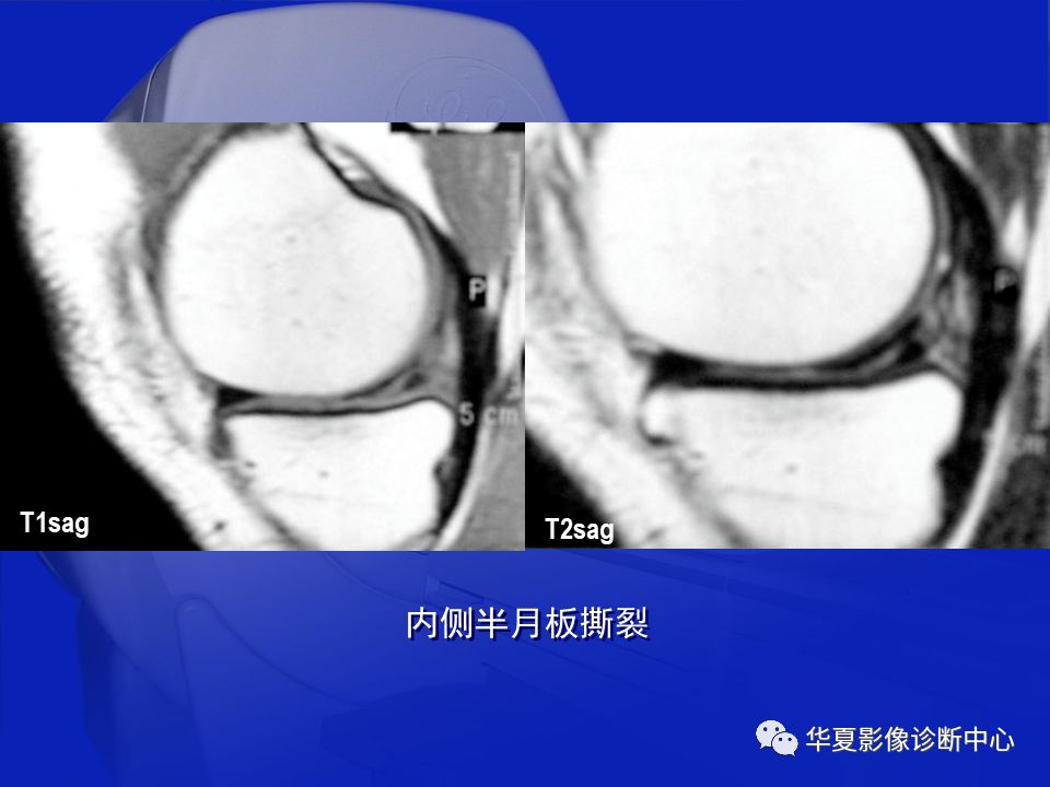 关于骨关节炎，这篇文章讲的太全了！