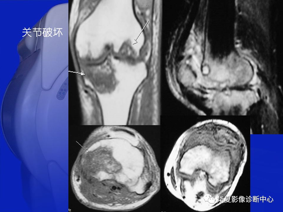 关于骨关节炎，这篇文章讲的太全了！