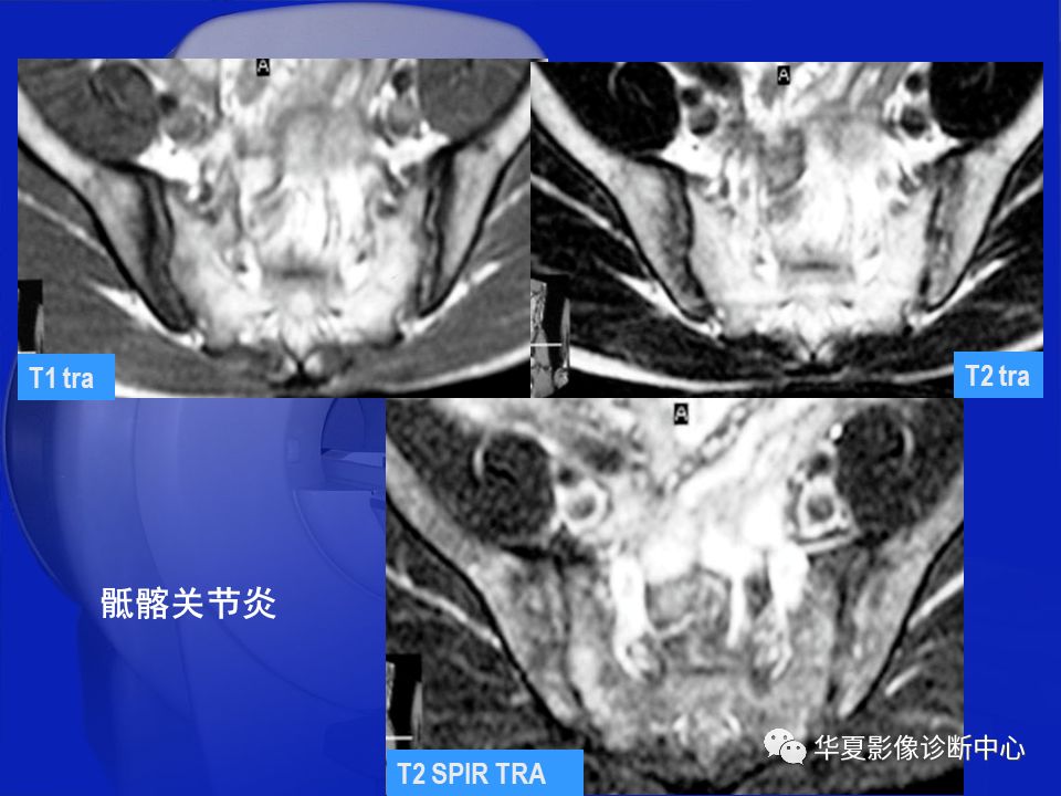 关于骨关节炎，这篇文章讲的太全了！