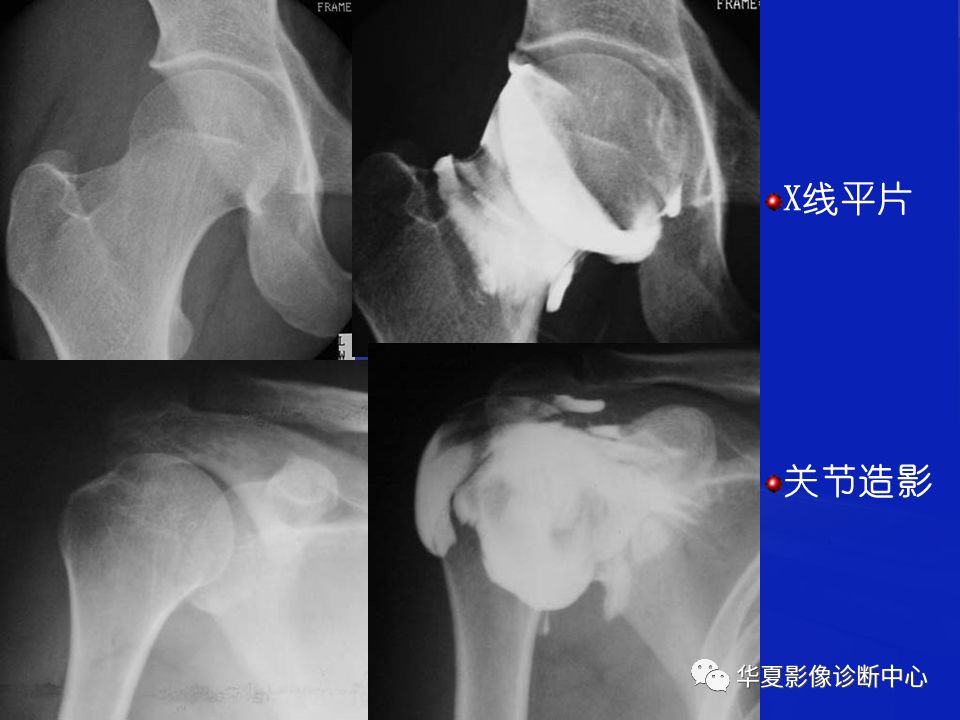 关于骨关节炎，这篇文章讲的太全了！