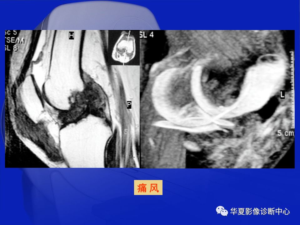 关于骨关节炎，这篇文章讲的太全了！