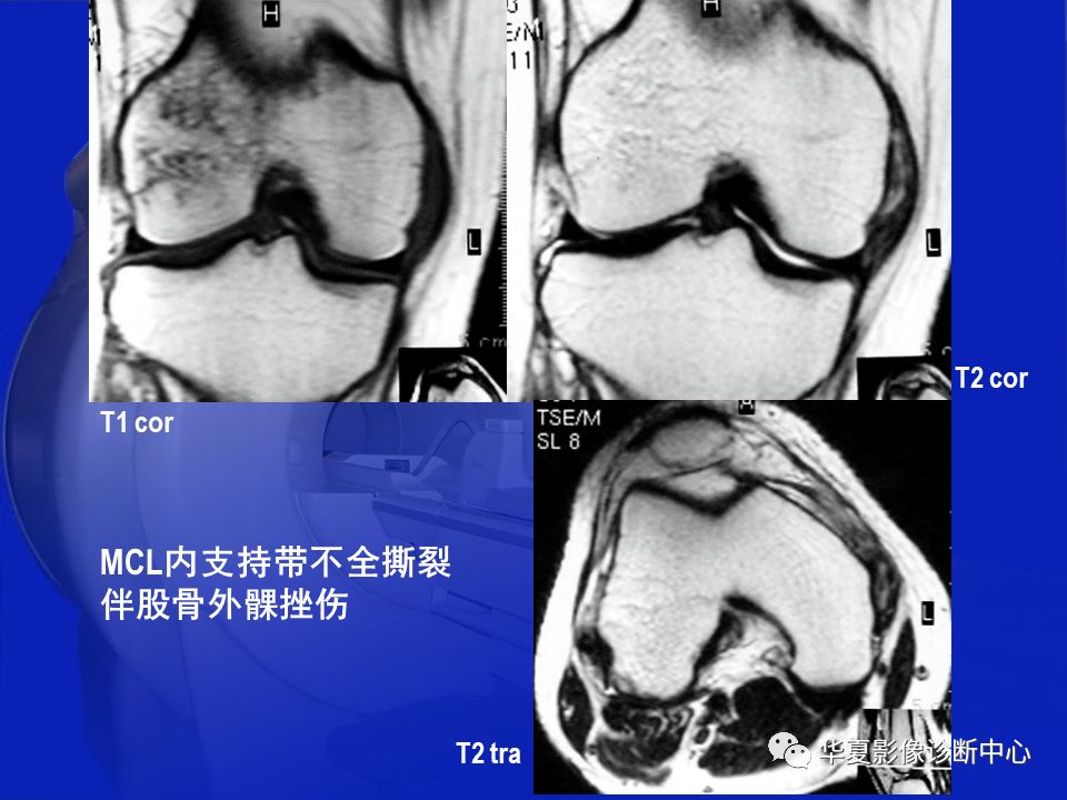 关于骨关节炎，这篇文章讲的太全了！