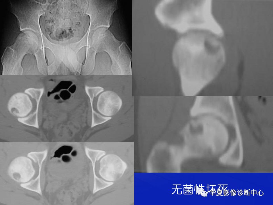 关于骨关节炎，这篇文章讲的太全了！