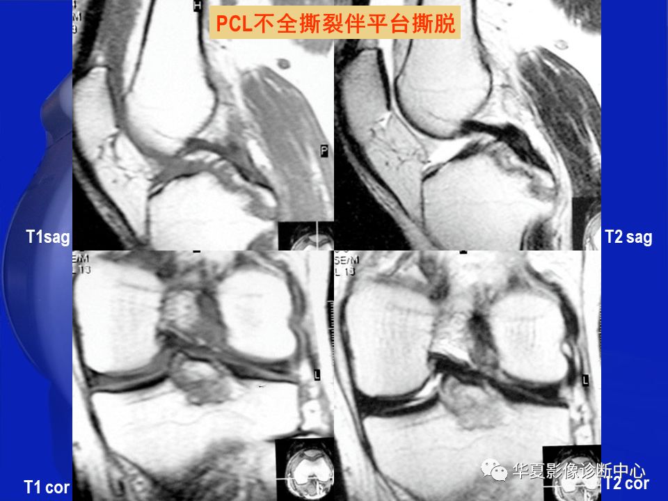 关于骨关节炎，这篇文章讲的太全了！