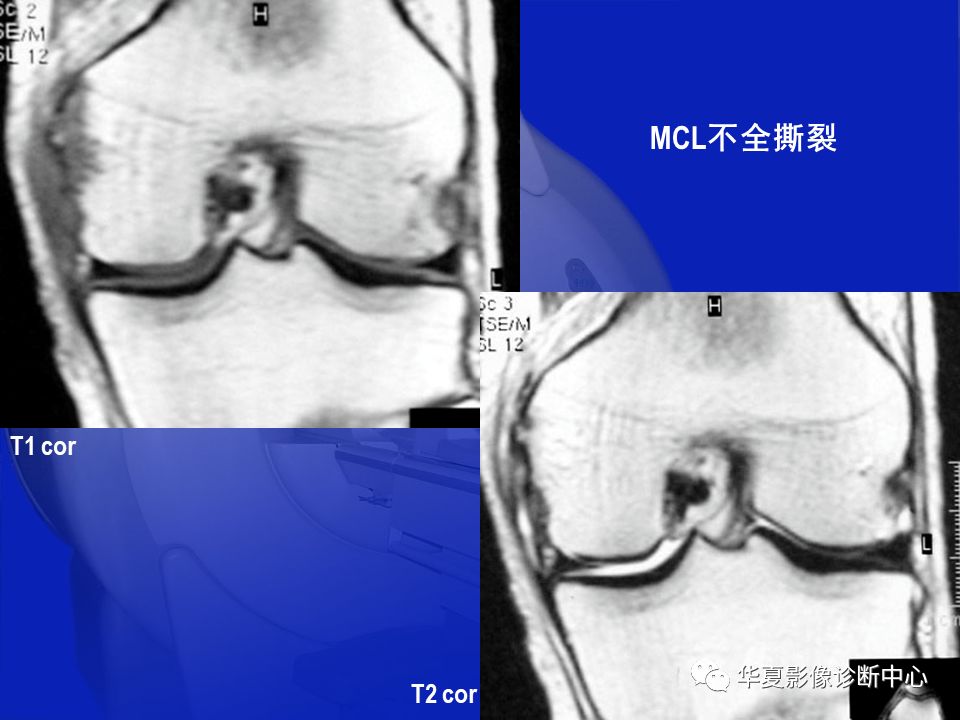 关于骨关节炎，这篇文章讲的太全了！