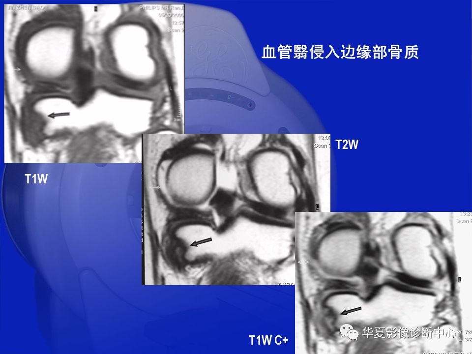 关于骨关节炎，这篇文章讲的太全了！