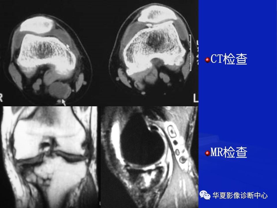 关于骨关节炎，这篇文章讲的太全了！