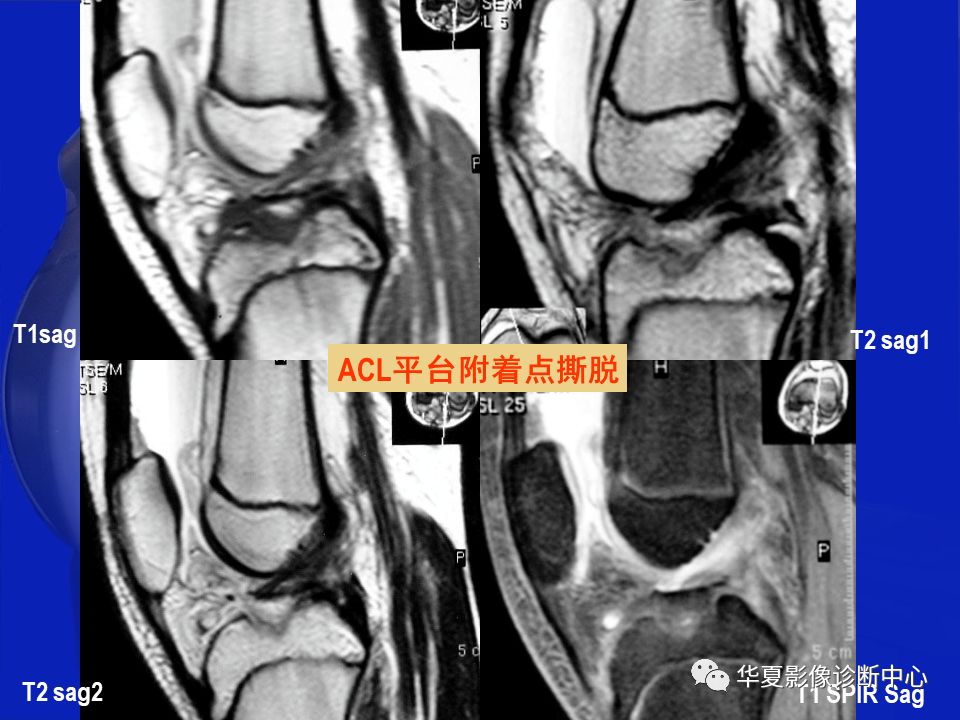 关于骨关节炎，这篇文章讲的太全了！