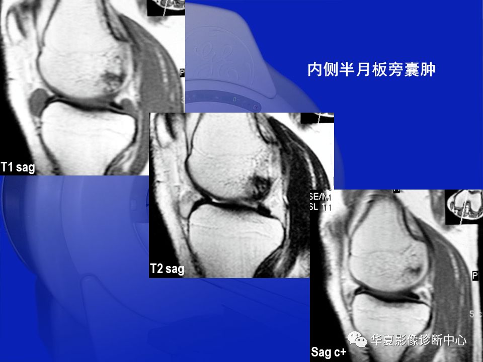 关于骨关节炎，这篇文章讲的太全了！