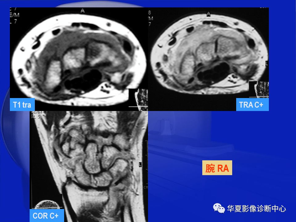 关于骨关节炎，这篇文章讲的太全了！