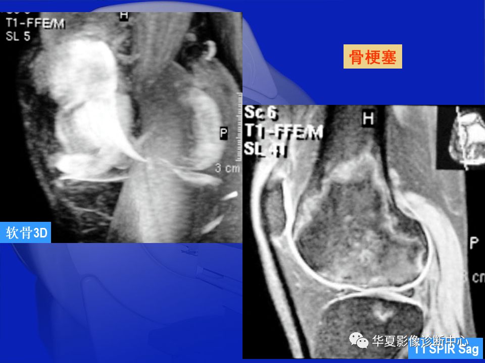 关于骨关节炎，这篇文章讲的太全了！