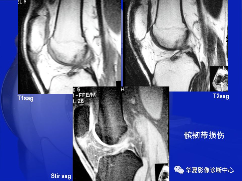 关于骨关节炎，这篇文章讲的太全了！