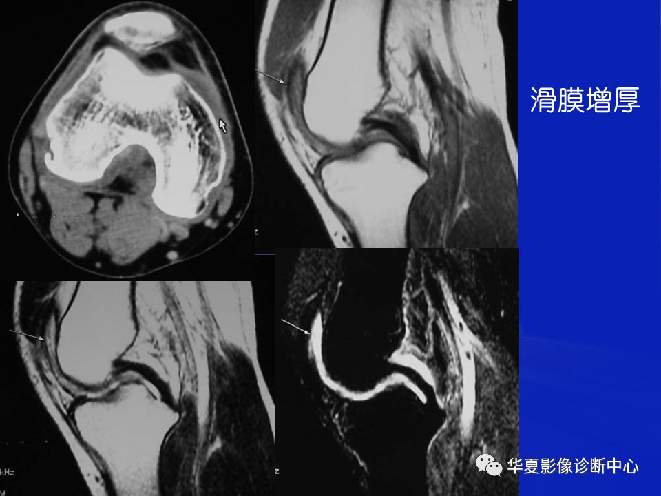 关于骨关节炎，这篇文章讲的太全了！