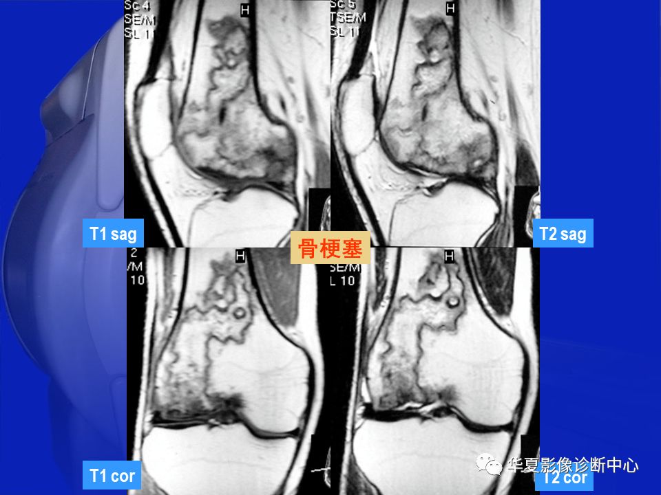 关于骨关节炎，这篇文章讲的太全了！