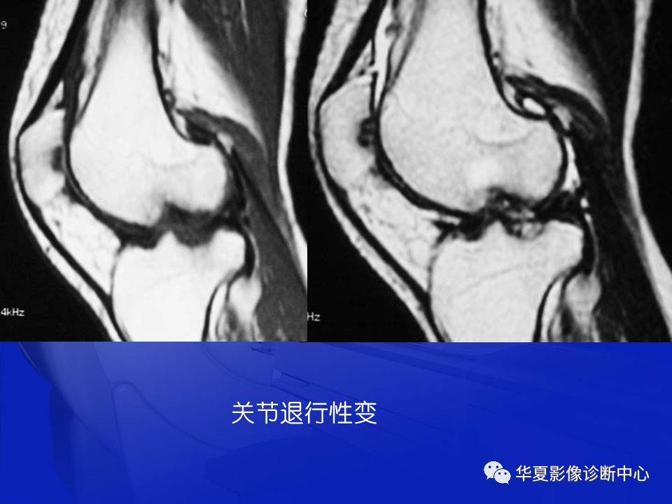 关于骨关节炎，这篇文章讲的太全了！