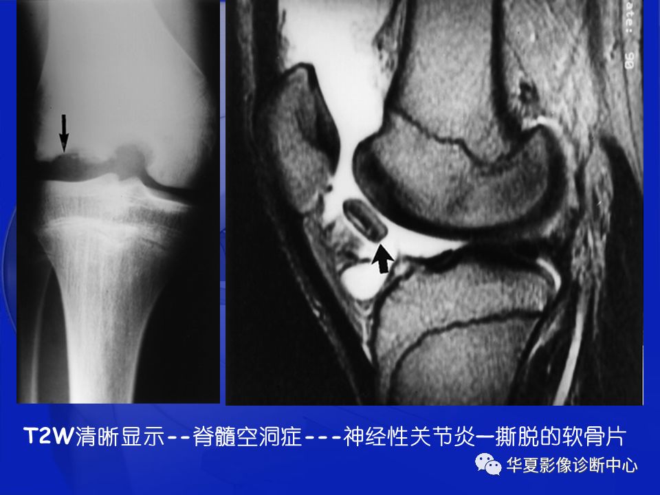 关于骨关节炎，这篇文章讲的太全了！