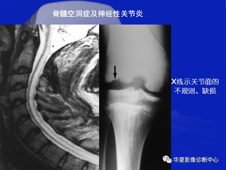 关于骨关节炎，这篇文章讲的太全了！