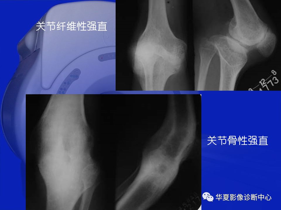 关于骨关节炎，这篇文章讲的太全了！