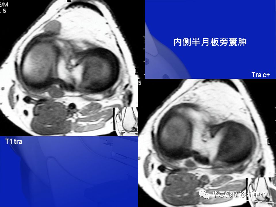 关于骨关节炎，这篇文章讲的太全了！