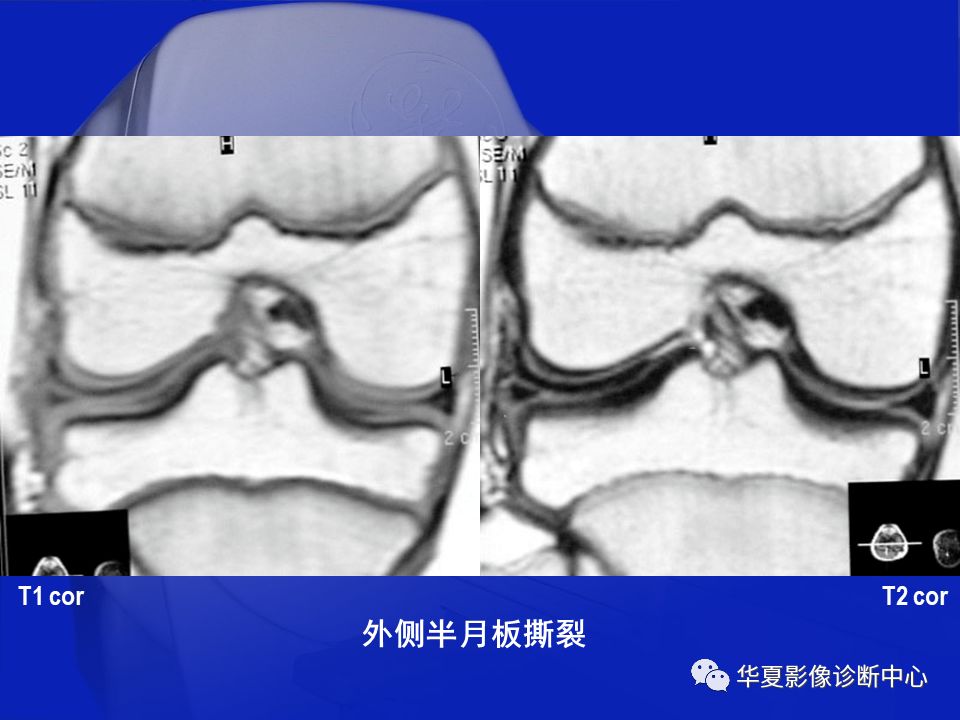 关于骨关节炎，这篇文章讲的太全了！