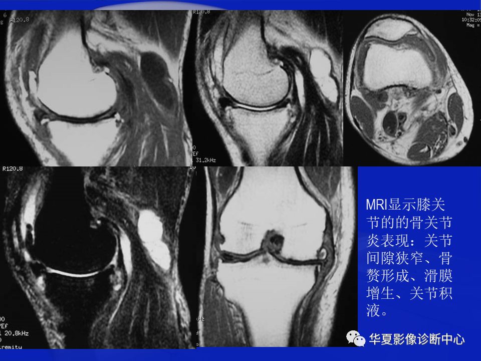 关于骨关节炎，这篇文章讲的太全了！