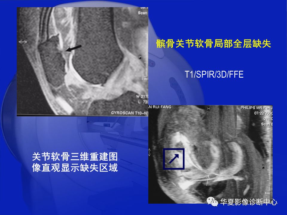 关于骨关节炎，这篇文章讲的太全了！