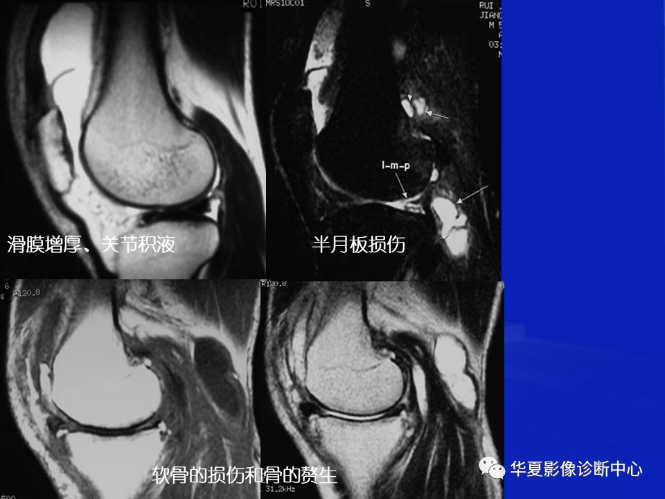 关于骨关节炎，这篇文章讲的太全了！