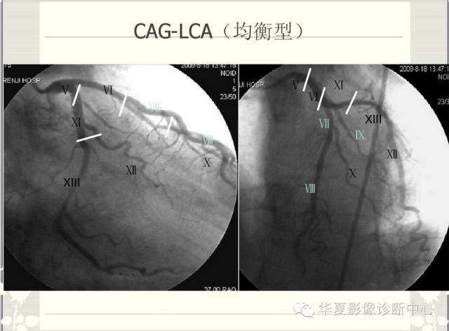 图文详解冠脉解剖及分段，值得收藏！