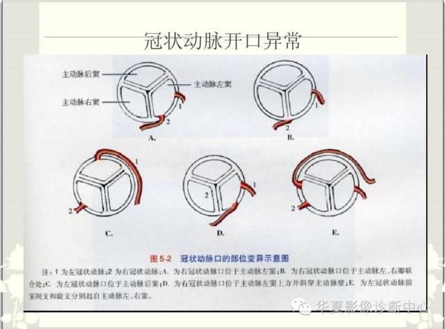 图文详解冠脉解剖及分段，值得收藏！