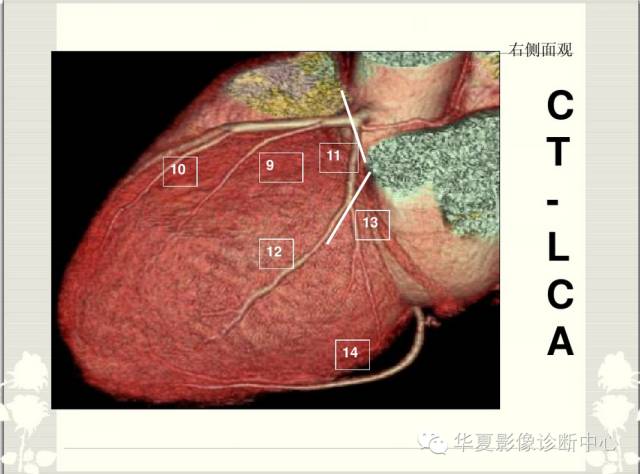 图文详解冠脉解剖及分段，值得收藏！