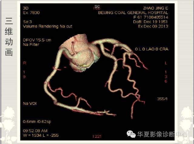 图文详解冠脉解剖及分段，值得收藏！