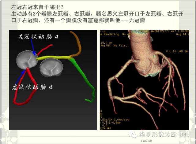 图文详解冠脉解剖及分段，值得收藏！