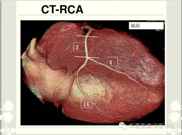 图文详解冠脉解剖及分段，值得收藏！