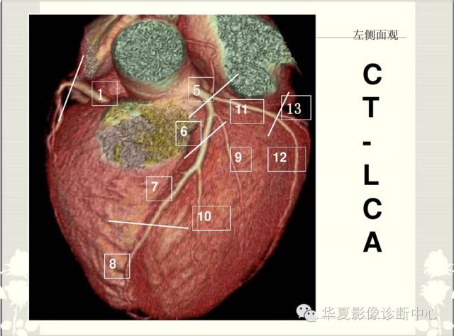 图文详解冠脉解剖及分段，值得收藏！