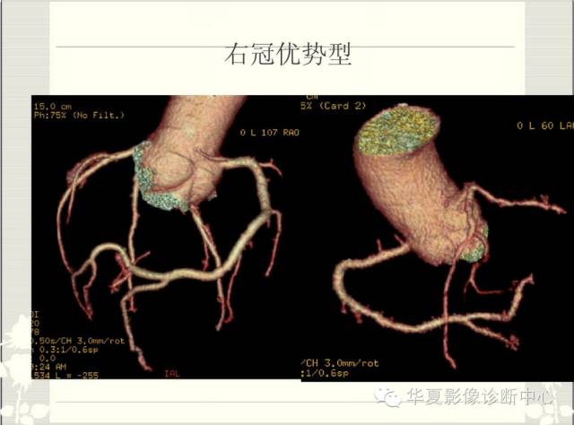 图文详解冠脉解剖及分段，值得收藏！