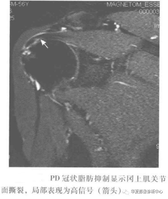 肩袖撕裂的这些知识你都掌握了吗？