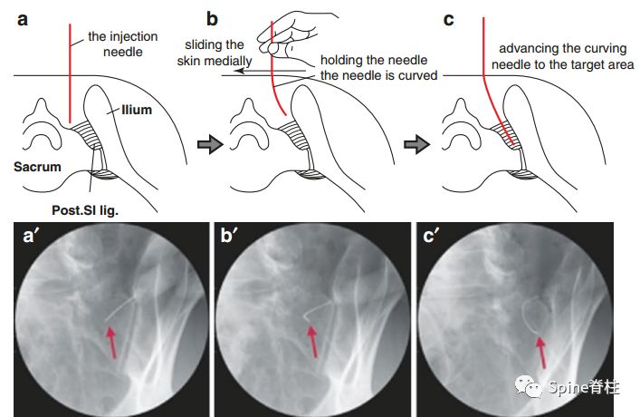 全面掌握：骶髂关节造影及阻滞技术详细操作技巧！