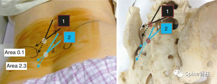 全面掌握：骶髂关节造影及阻滞技术详细操作技巧！