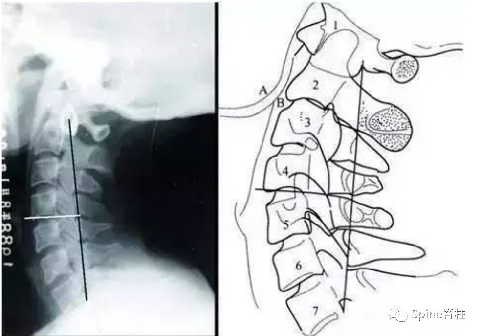 干货！颈椎