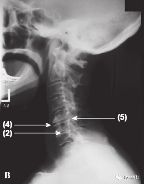 干货！颈椎