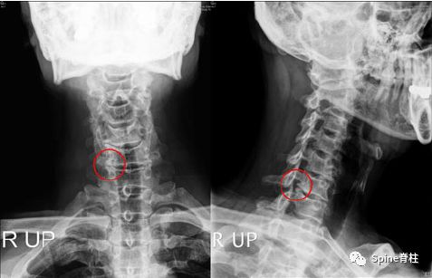 颈椎X线片能给我们诊断带来那些提示呢？