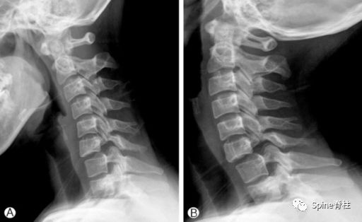 颈椎X线片能给我们诊断带来那些提示呢？