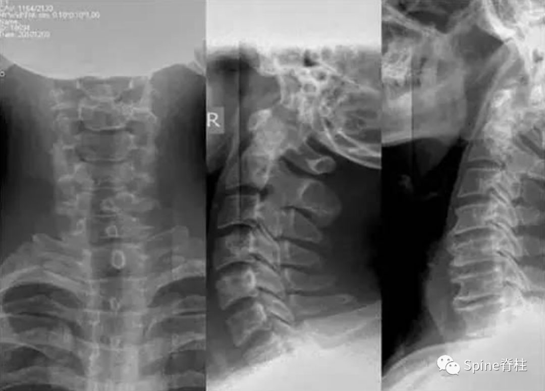 颈椎X线片能给我们诊断带来那些提示呢？