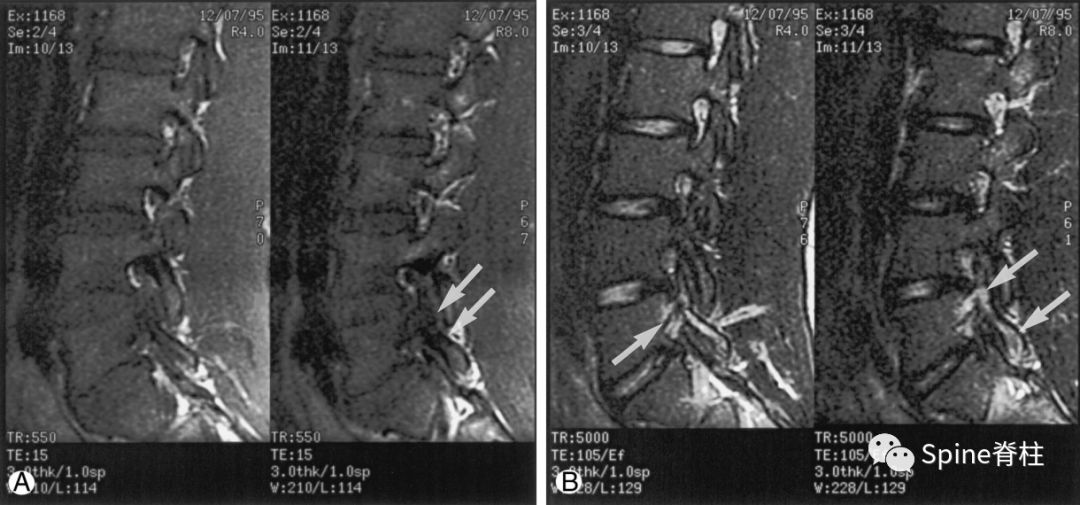 荐读收藏：青少年慢性腰痛常见原因