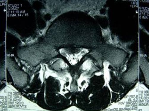 荐读收藏：青少年慢性腰痛常见原因
