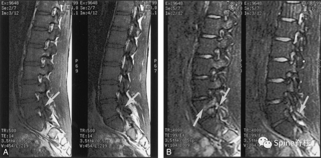 荐读收藏：青少年慢性腰痛常见原因